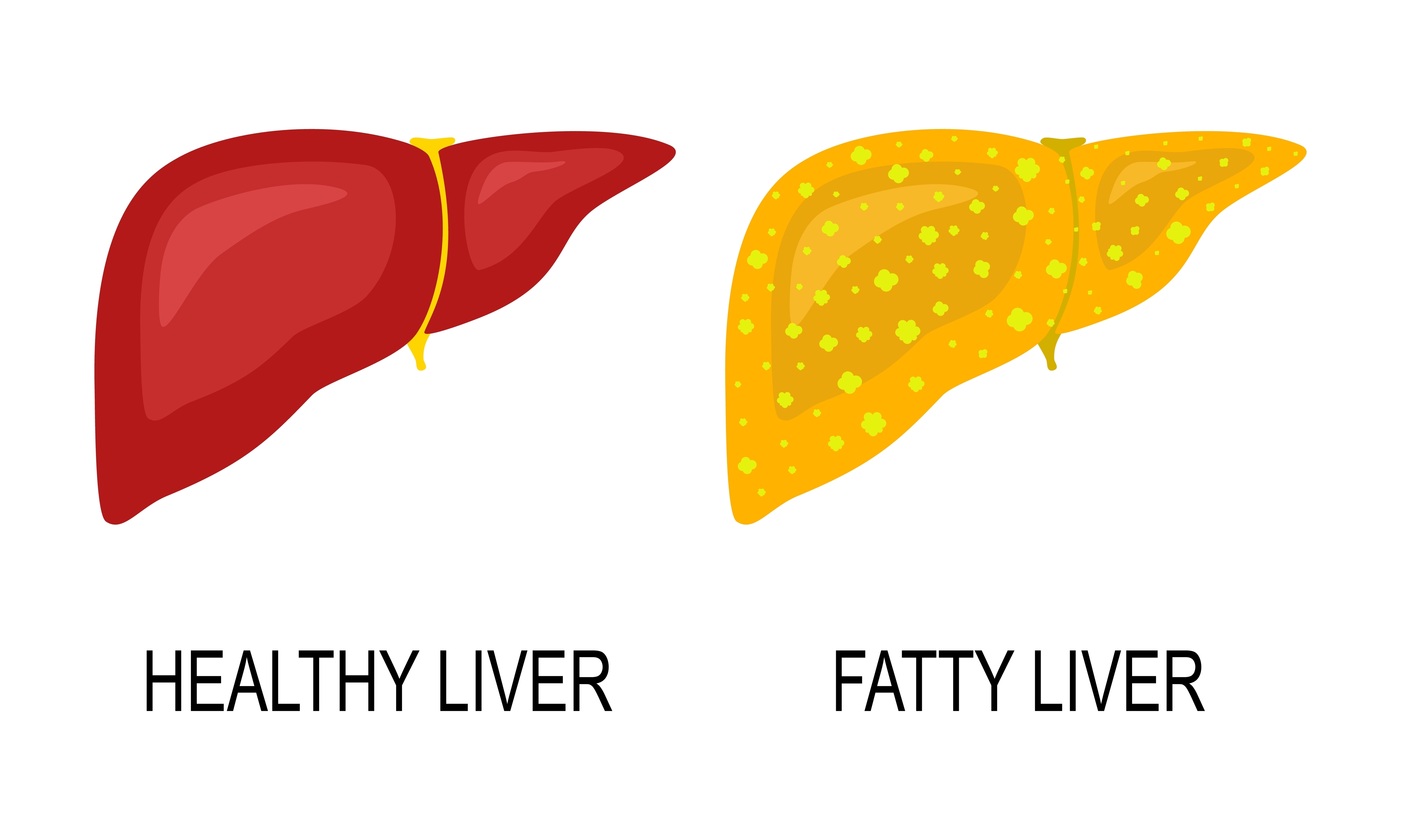 Når leveren bliver for fed